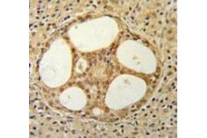 Immunohistochemistry analysis in prostate carcinoma (Formalin-fixed, Paraffin-embedded) using PRUNE  Antibody (C-term), followed by peroxidase conjugation of the secondary antibody and DAB staining. (PRUNE antibody  (C-Term))