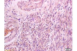 Formalin-fixed and paraffin embedded human lung carcinoma labeled with Rabbit Anti Phospho-Talin (Ser425) Polyclonal Antibody, Unconjugated (ABIN703135) at 1:200 followed by conjugation to the secondary antibody and DAB staining (Talin antibody  (pSer425))