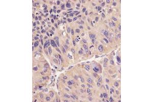 B staining hFACL4 in human human hepatocarcinoma sections by Immunohistochemistry (IHC-P - paraformaldehyde-fixed, paraffin-embedded sections). (ACSL4 antibody  (AA 236-267))