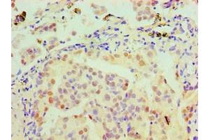 Immunohistochemical of paraffin-embedded Human lung cancer tissue using ABIN7160272 at dilution of 1:200. (MSH6 antibody)