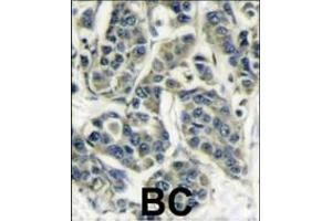 Formalin-fixed and paraffin-embedded human breast carcinoma reacted with RPS6KB1 Antibody (Center) (ABIN389685 and ABIN2839654) , which was peroxidase-conjugated to the secondary antibody, followed by DAB staining. (RPS6KB1 antibody  (AA 277-306))