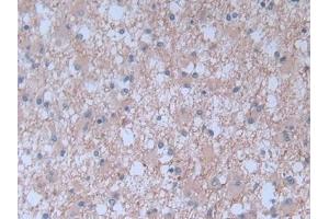 Detection of BNP in Human Glioma Tissue using Monoclonal Antibody to Brain Natriuretic Peptide (BNP) (BNP antibody)