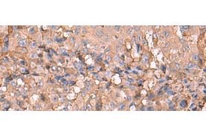 Immunohistochemistry of paraffin-embedded Human liver cancer tissue using NOTCH4 Polyclonal Antibody at dilution of 1:30(x200) (NOTCH4 antibody)