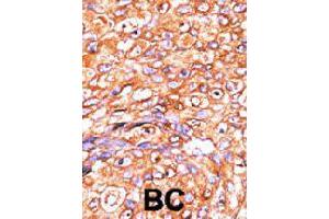 Formalin-fixed and paraffin-embedded human breast cancer tissue reacted with DUSP10 polyclonal antibody  , which was peroxidase-conjugated to the secondary antibody, followed by AEC staining. (DUSP10 antibody  (N-Term))