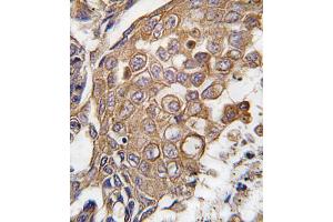 Formalin-fixed and paraffin-embedded human lung carcinoma tissue reacted with ALOX5 antibody (Center), which was peroxidase-conjugated to the secondary antibody, followed by DAB staining. (ALOX5AP antibody  (AA 86-117))