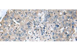 Immunohistochemistry of paraffin-embedded Human liver cancer tissue using TGM3 Polyclonal Antibody at dilution of 1:55(x200) (TGM3 antibody)