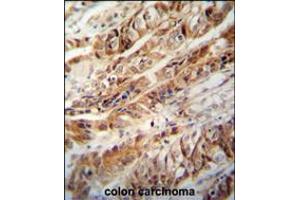ZC3H15 antibody immunohistochemistry analysis in formalin fixed and paraffin embedded human colon carcinoma followed by peroxidase conjugation of the secondary antibody and DAB staining. (ZC3H15 antibody  (C-Term))