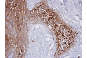 IHC-P Image Immunohistochemical analysis of paraffin-embedded CA922 xenograft, using WBSCR22 , antibody at 1:100 dilution. (WBSCR22 antibody  (Center))