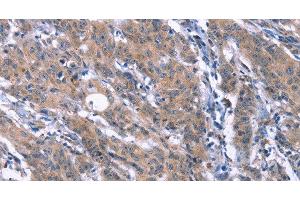 Immunohistochemistry of paraffin-embedded Human gasrtic cancer tissue using ESPL1 Polyclonal Antibody at dilution 1:40 (Separase antibody)