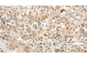 Immunohistochemistry of paraffin-embedded Human esophagus cancer tissue using TSPYL2 Polyclonal Antibody at dilution 1:30 (TSPY-Like 2 antibody)