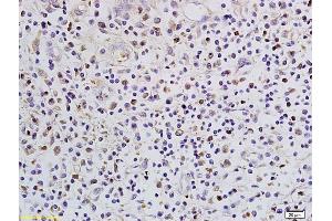 Formalin-fixed and paraffin embedded human colon cancer labeled with Anti-SATB1 Polyclonal Antibody, Unconjugated (ABIN732008) followed by conjugation to the secondary antibody and DAB staining (SATB1 antibody  (AA 671-764))