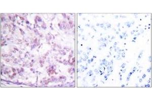Immunohistochemistry analysis of paraffin-embedded human breast carcinoma tissue, using MYB (Ab-12) Antibody. (MYB antibody  (AA 1-50))