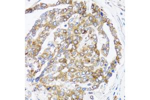 Immunohistochemistry of paraffin-embedded human liver cancer using BCAP29 antibody (ABIN5973749) at dilution of 1/100 (40x lens). (BCAP29 antibody)