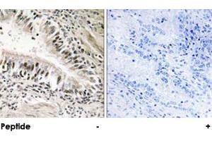Immunohistochemical analysis of paraffin-embedded human lung carcinoma tissue using STK11 polyclonal antibody . (LKB1 antibody)