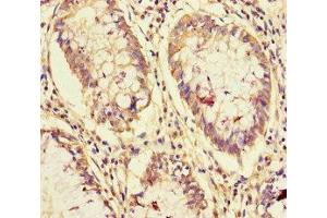 Immunohistochemistry of paraffin-embedded human colon cancer using ABIN7161865 at dilution of 1:100 (NCOA6 antibody  (AA 285-504))
