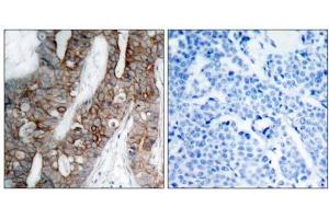 Immunohistochemical analysis of paraffin-embedded human breast carcinoma tissue using Integrin β3 (Ab-773) antibody (E021082). (Integrin beta 3 antibody)