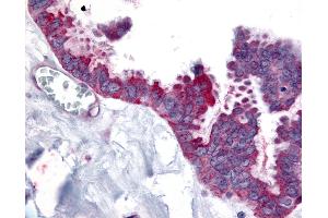 Anti-WNT2B antibody IHC of human Ovary, Carcinoma. (WNT2B antibody  (N-Term))