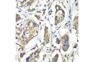 Immunohistochemistry of paraffin-embedded human liver cancer using NFS1 antibody at dilution of 1:100 (x40 lens). (NFS1 antibody)