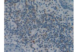 IHC-P analysis of Human Skin cancer Tissue, with DAB staining. (Fibrillin 1 antibody  (AA 723-902))