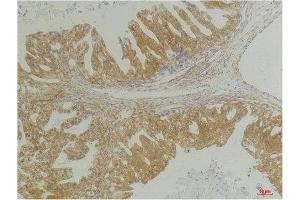 Immunohistochemistry (IHC) analysis of paraffin-embedded Human Breast Carcinoma using CXCR4 Rabbit Polyclonal Antibody diluted at 1:200. (CXCR4 antibody)