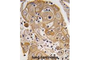 Formalin-fixed and paraffin-embedded human lung carcinoma tissue reacted with PTRF antibody (N-term) (ABIN391621 and ABIN2841540) , which was peroxidase-conjugated to the secondary antibody, followed by DAB staining. (PTRF antibody  (N-Term))