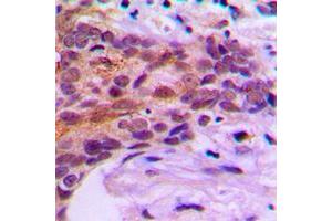 Immunohistochemical analysis of MOB1B staining in human prostate cancer formalin fixed paraffin embedded tissue section. (MOBKL1A antibody  (Center))