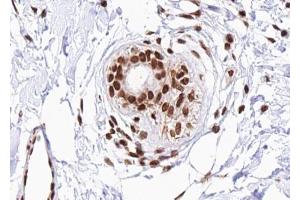 ABIN6267488 at 1/100 staining human Breast carcinoma tissue sections by IHC-P. (DDIT3 antibody  (pSer30))