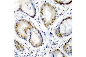 Immunohistochemistry of paraffin-embedded human colon carcinoma using SS18 antibody (ABIN5975075) at dilution of 1/200 (40x lens). (SS18 antibody)