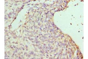 Immunohistochemistry of paraffin-embedded human endometrial cancer using ABIN7155457 at dilution of 1:100 (RBBP7 antibody  (AA 1-230))