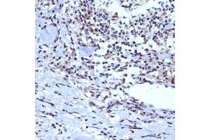 Immunohistochemistry of paraffin-embedded human esophageal cancer using A Rabbit mAb (ABIN7265387) at dilution of 1:100 (40x lens). (BAF53A antibody)