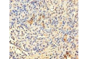 Immunohistochemistry of paraffin-embedded human bladder cancer using ABIN7172423 at dilution of 1:100 (TCEANC2 antibody  (N-Term))