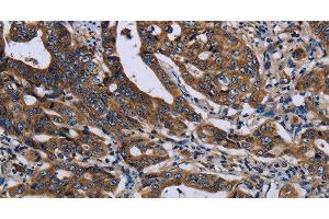 Immunohistochemistry of paraffin-embedded Human gastic cancer using LZTFL1 Polyclonal Antibody at dilution of 1:50 (LZTFL1 antibody)