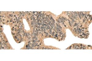 Immunohistochemistry of paraffin-embedded Human colorectal cancer tissue using CCNB1IP1 Polyclonal Antibody at dilution of 1:30(x200) (CCNB1IP1 antibody)