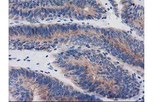 Immunohistochemical staining of paraffin-embedded Adenocarcinoma of Human endometrium tissue using anti-BIN3 mouse monoclonal antibody. (BIN3 antibody)