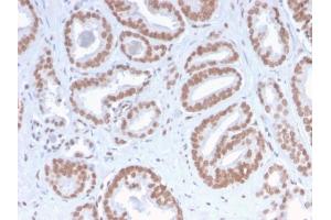 Formalin-fixed, paraffin-embedded human Prostate Carcinoma stained with ATRX Rabbit Recombinant Monoclonal Antibody (ATRX/2900R). (Recombinant ATRX antibody)