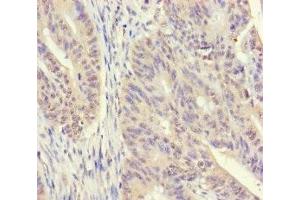 Immunohistochemistry of paraffin-embedded human colon cancer using ABIN7170541 at dilution of 1:100 (Spermidine Synthase antibody  (AA 17-302))