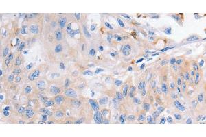 Immunohistochemistry of paraffin-embedded Human cervical cancer using KCNA1 Polyclonal Antibody at dilution of 1:30 (KCNA1 antibody)
