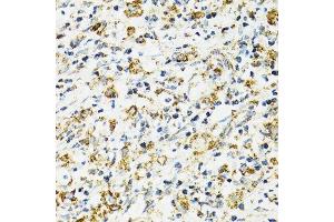 Immunohistochemistry of paraffin-embedded human uterine cancer using HSPA9 antibody.