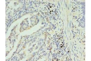 Immunohistochemistry of paraffin-embedded human lung cancer using ABIN7170235 at dilution of 1:100 (SLC35F5 antibody  (AA 122-242))