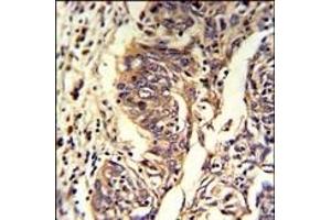 Formalin-fixed and paraffin-embedded human lung carcinoma reacted with KYNU Antibody (C-term), which was peroxidase-conjugated to the secondary antibody, followed by DAB staining. (KYNU antibody  (C-Term))