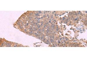 Immunohistochemistry of paraffin-embedded Human liver cancer tissue using KCNU1 Polyclonal Antibody at dilution of 1:45(x200) (KCNU1 antibody)