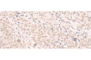 Immunohistochemistry of paraffin-embedded Human ovarian cancer tissue using HOOK2 Polyclonal Antibody at dilution of 1:30(x200)