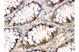 Anti- liver FABP Picoband antibody,IHC(P) IHC(P): Human Intestinal Cancer Tissue (FABP1 antibody  (N-Term))
