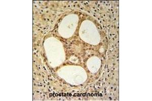 PRUNE Antibody (C-term) (ABIN653704 and ABIN2843021) IHC analysis in formalin fixed and paraffin embedded prostate carcinoma followed by peroxidase conjugation of the secondary antibody and DAB staining. (PRUNE antibody  (C-Term))