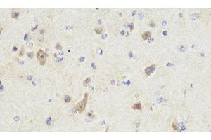 Immunohistochemistry analysis of paraffin-embedded Human brain cancer using NOS1 Polyclonal Antibody at dilution of 1:300. (NOS1 antibody)