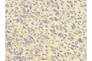 Immunohistochemistry of paraffin-embedded human glioma using ABIN7152623 at dilution of 1:100