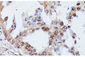 Immunohistochemistry of paraffin-embedded Human lung cancer using IGHMBP2 Polyclonal Antibody at dilution of 1:100 (40x lens). (IGHMBP2 antibody)