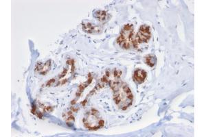 Formalin-fixed, paraffin-embedded human Breast Carcinoma stained with Purified GST Mu3 Mouse Monoclonal Antibody (CPTC- GSTMu3-1). (GSTM3 antibody)