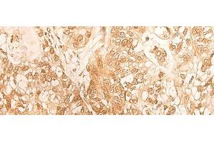 Immunohistochemistry of paraffin-embedded Human gastric cancer tissue using DBP Polyclonal Antibody at dilution of 1:25(x200) (DBP antibody)