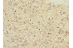 Immunohistochemistry of paraffin-embedded human glioma using ABIN7166554 at dilution of 1:100 (Protocadherin 1 antibody  (AA 515-715))